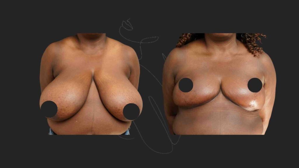 Breast Reduction & Breast Lift