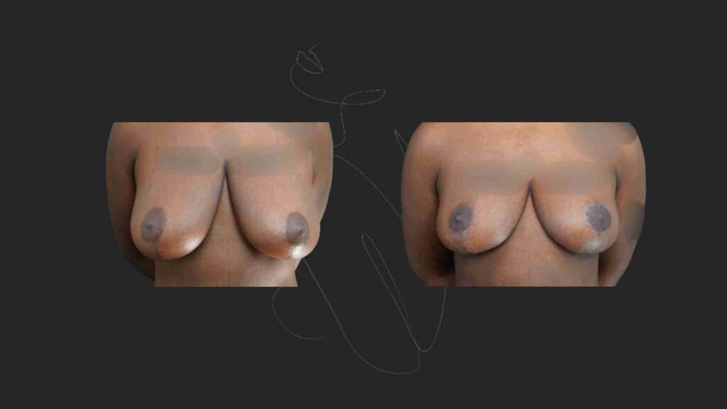 Breast Reduction Breast lift