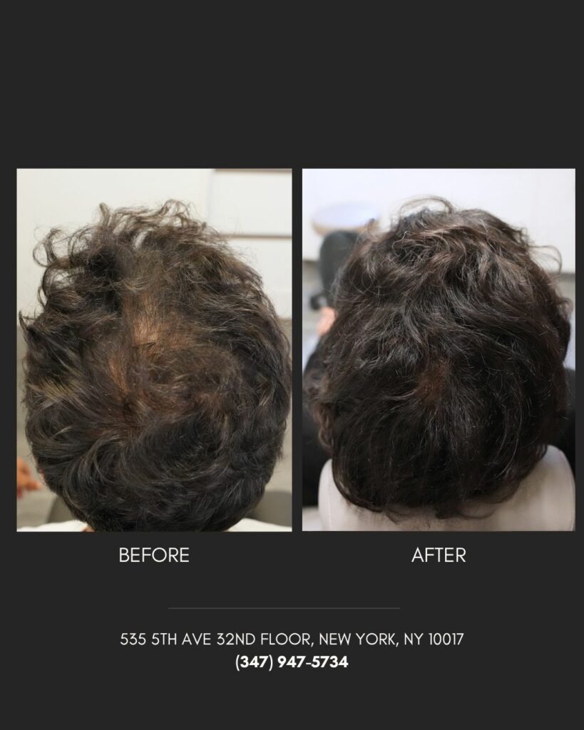 Hair Restoration
