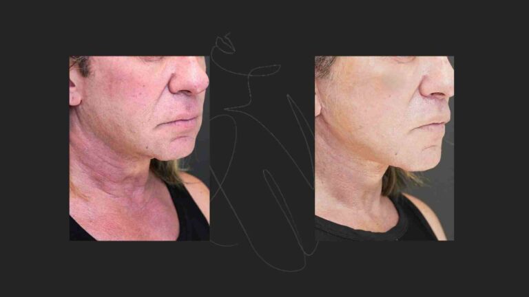 Neck Lift NYC