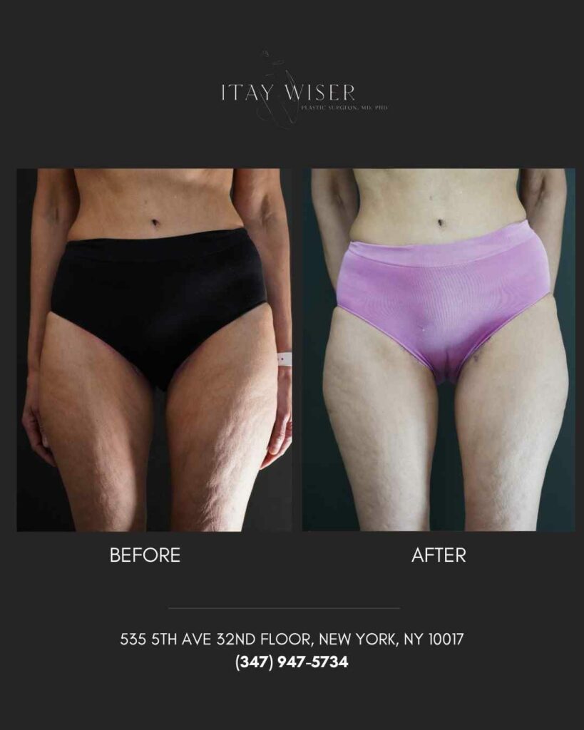 Thigh Lift NYC