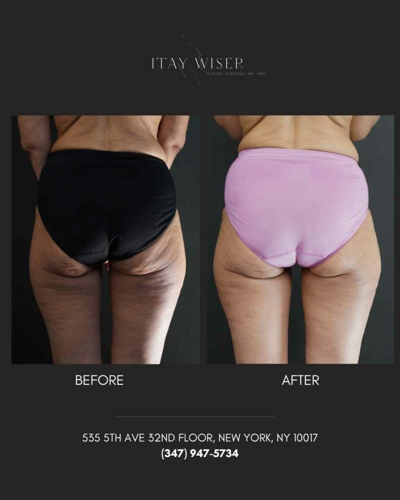 Thigh Lift NYC