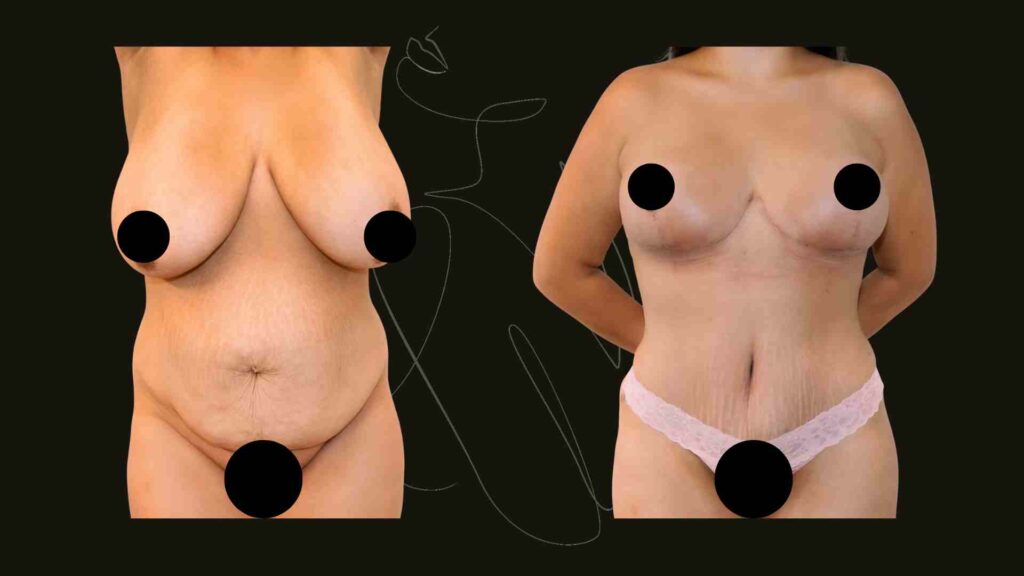 Breast Reduction NYC
