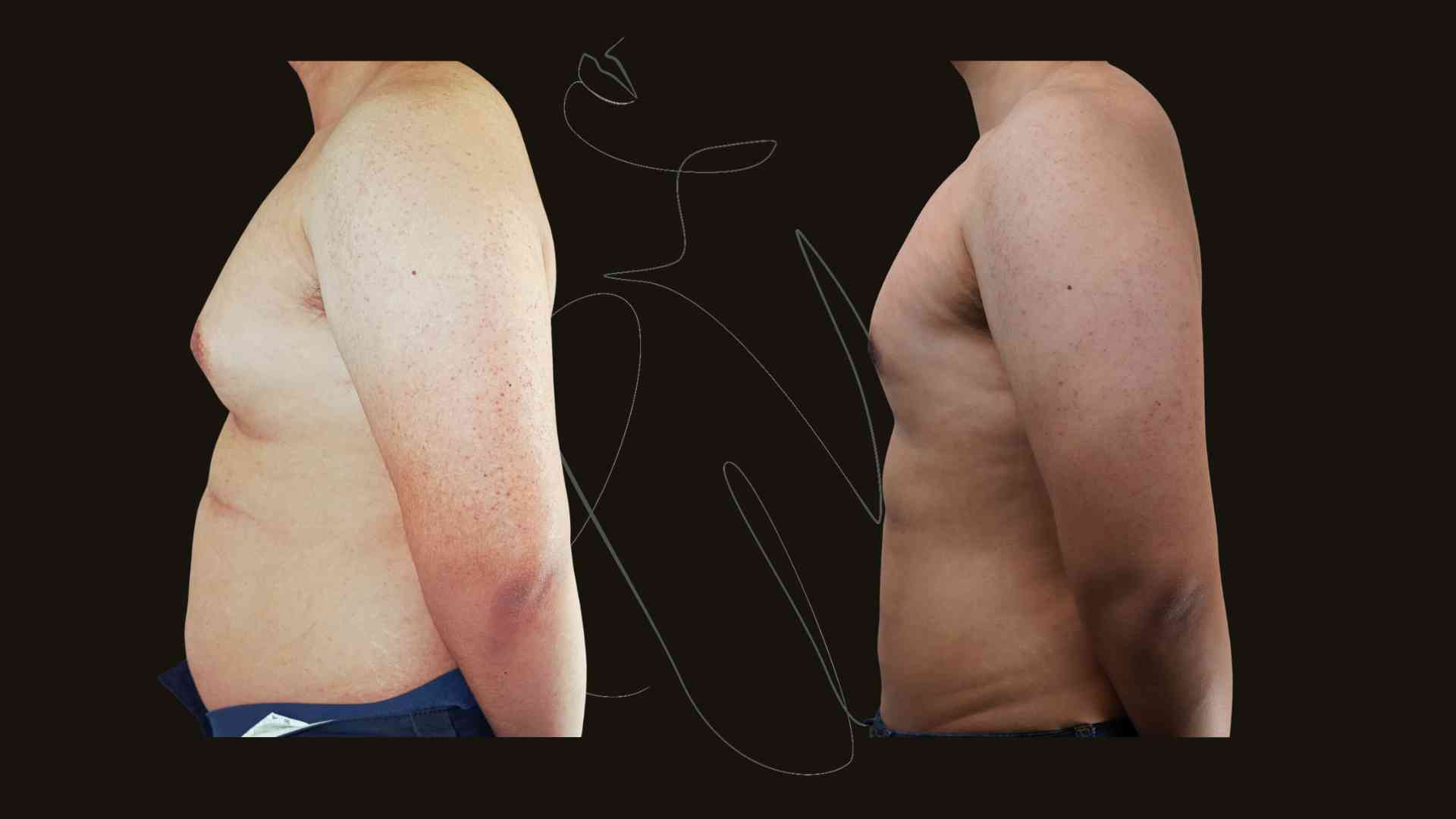 Gynecomastia