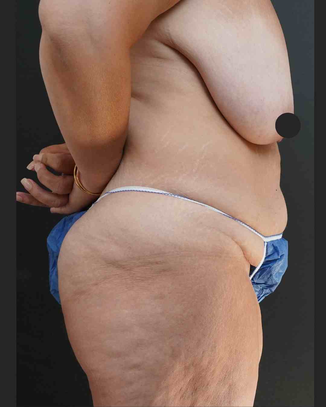 Mommy Makeover before after