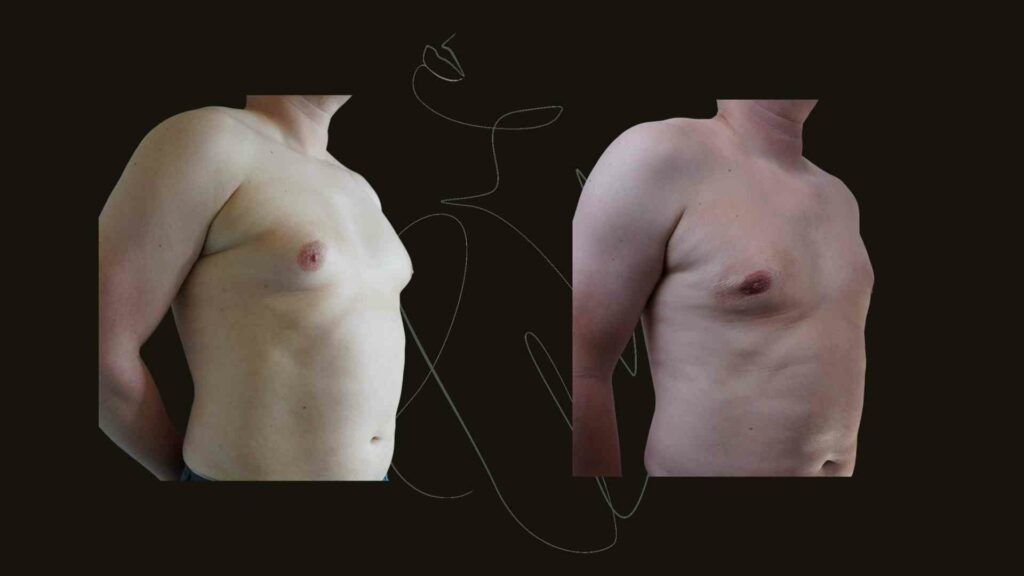 Gynecomastia