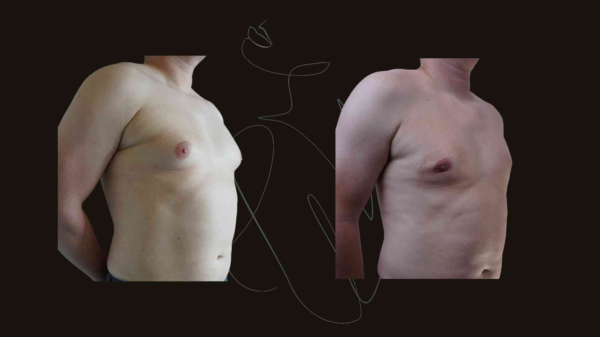 Gynecomastia