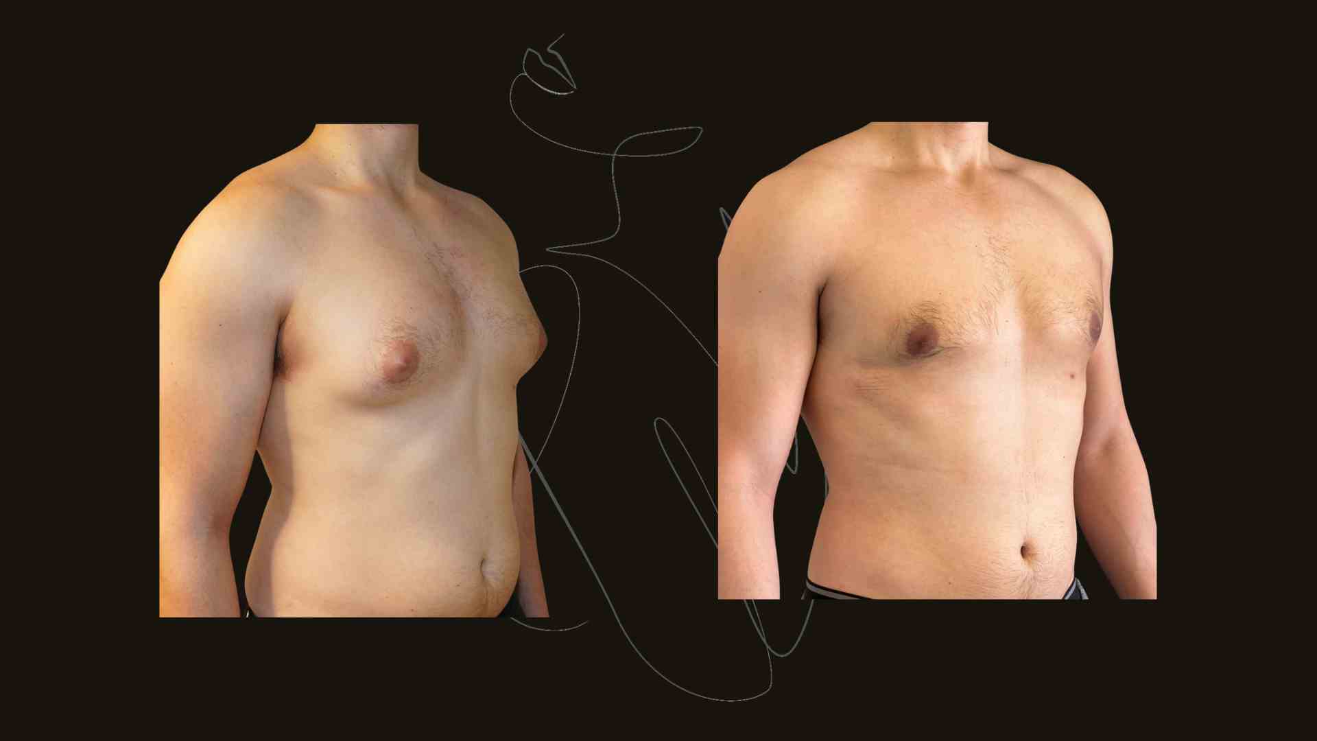 Gynecomastia
