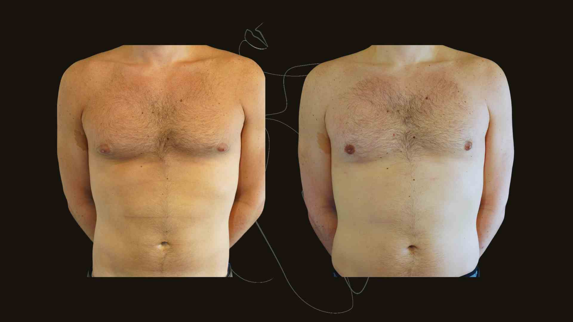 Gynecomastia