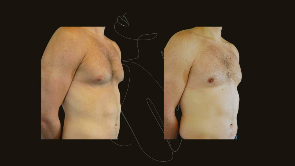 Gynecomastia