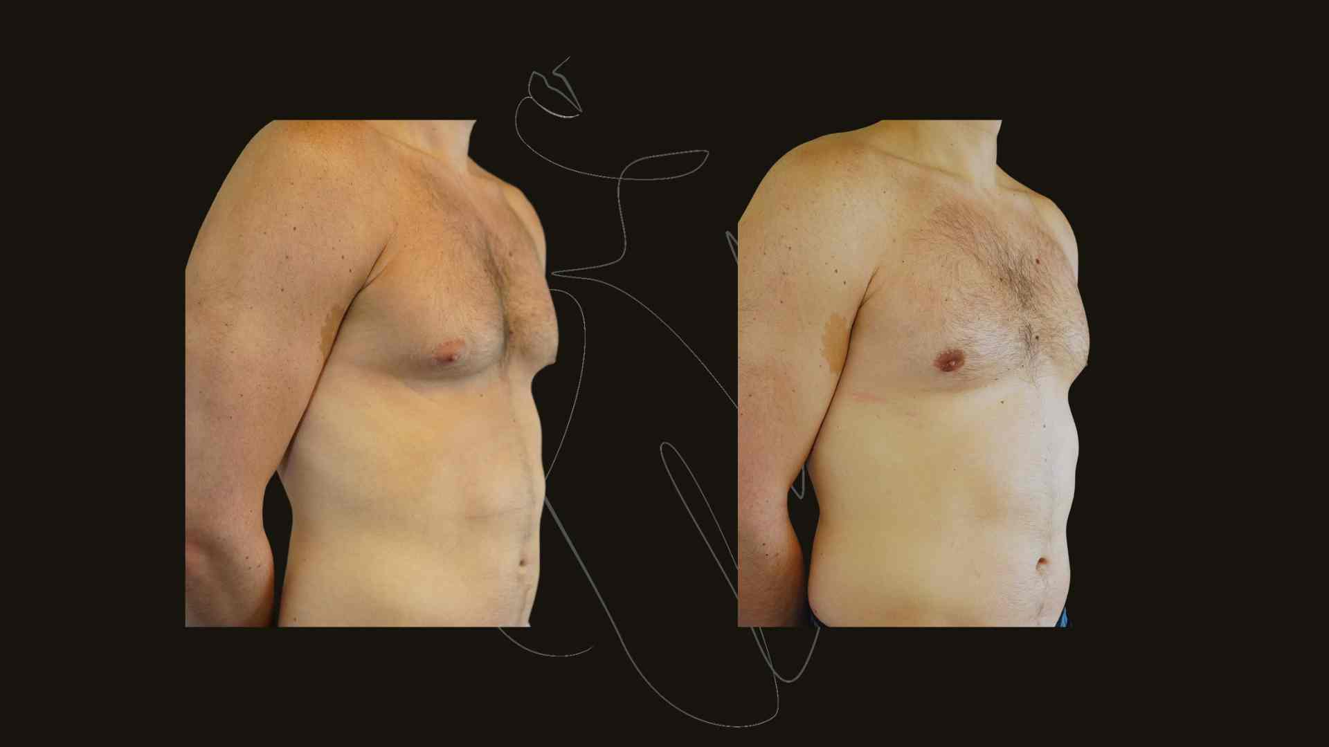 Gynecomastia