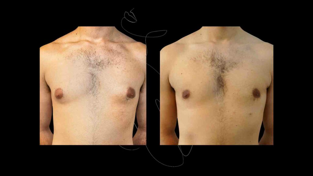 Gynecomastia