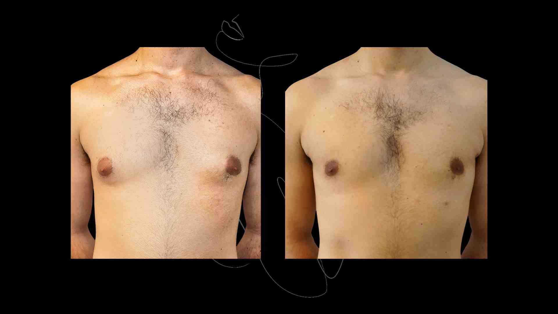 Gynecomastia