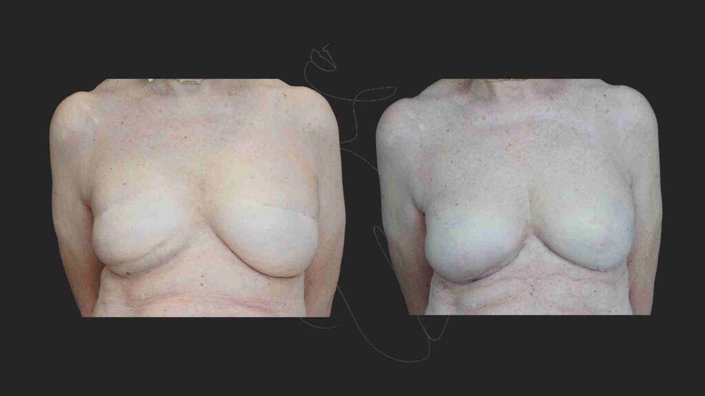 Breast Reconstruction in NYC DIEP