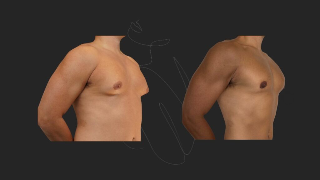 Gynecomastia NYC
