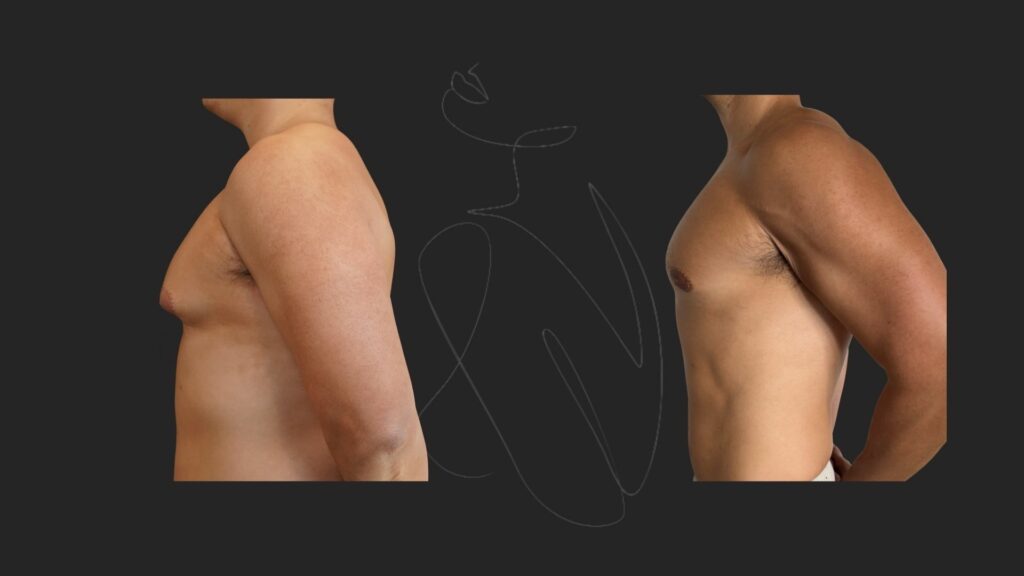 Gynecomastia NYC