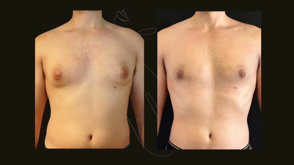 Gynecomastia NYC