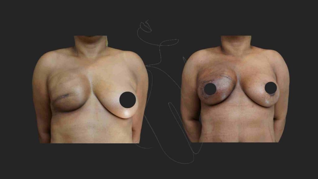 Breast Reconstruction in NYC DIEP