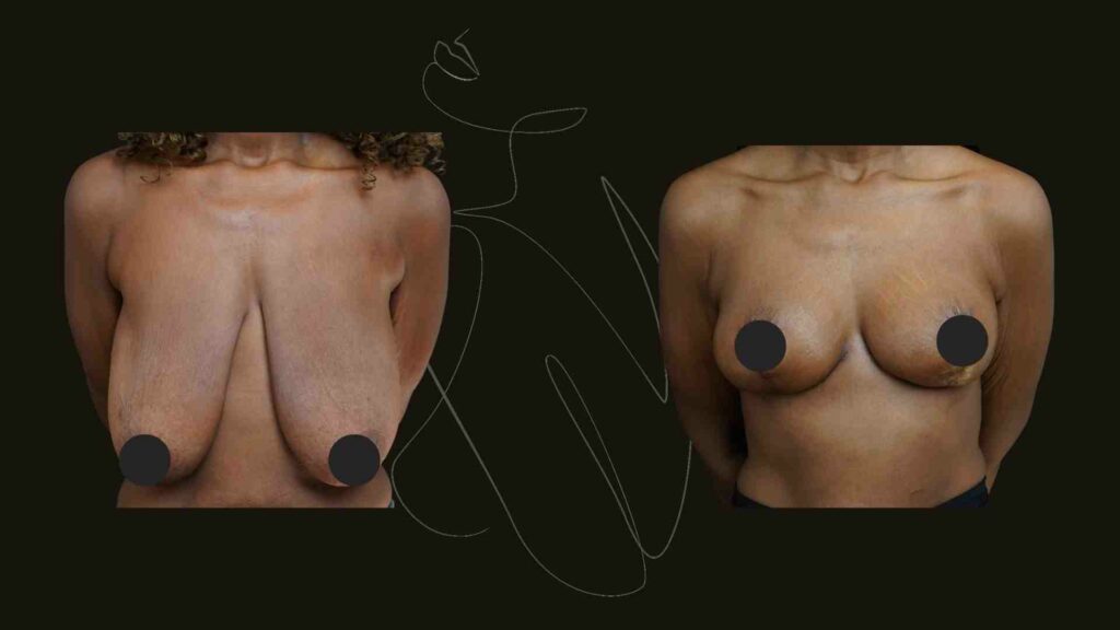 breast reduction