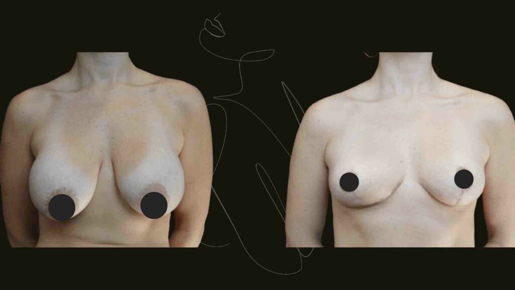 breast reduction