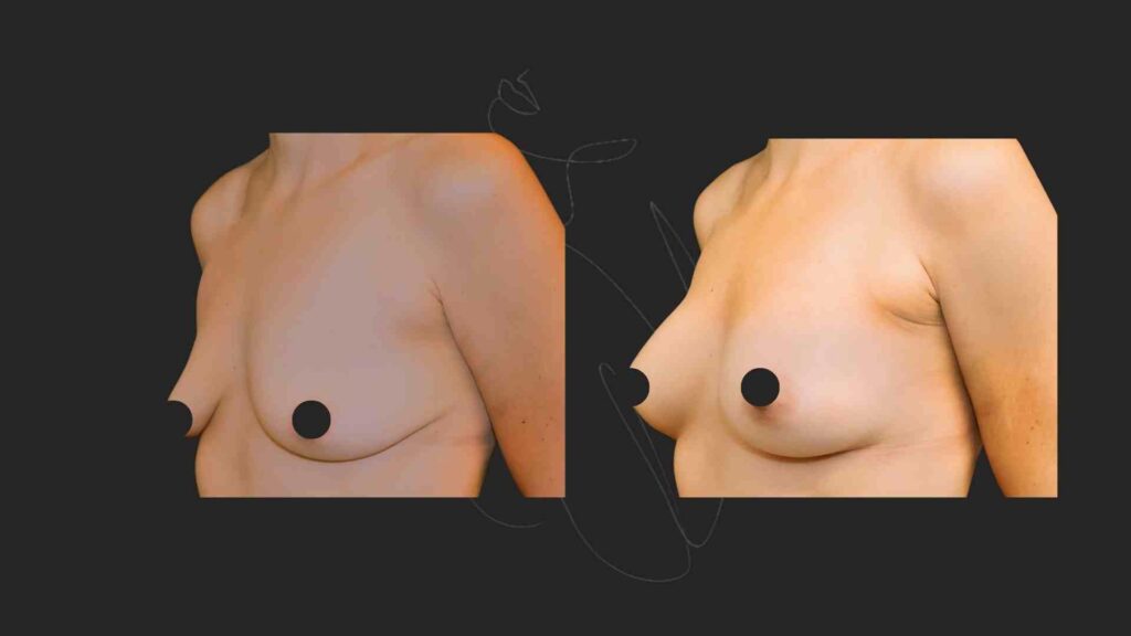 Breast Augmentation NYC
