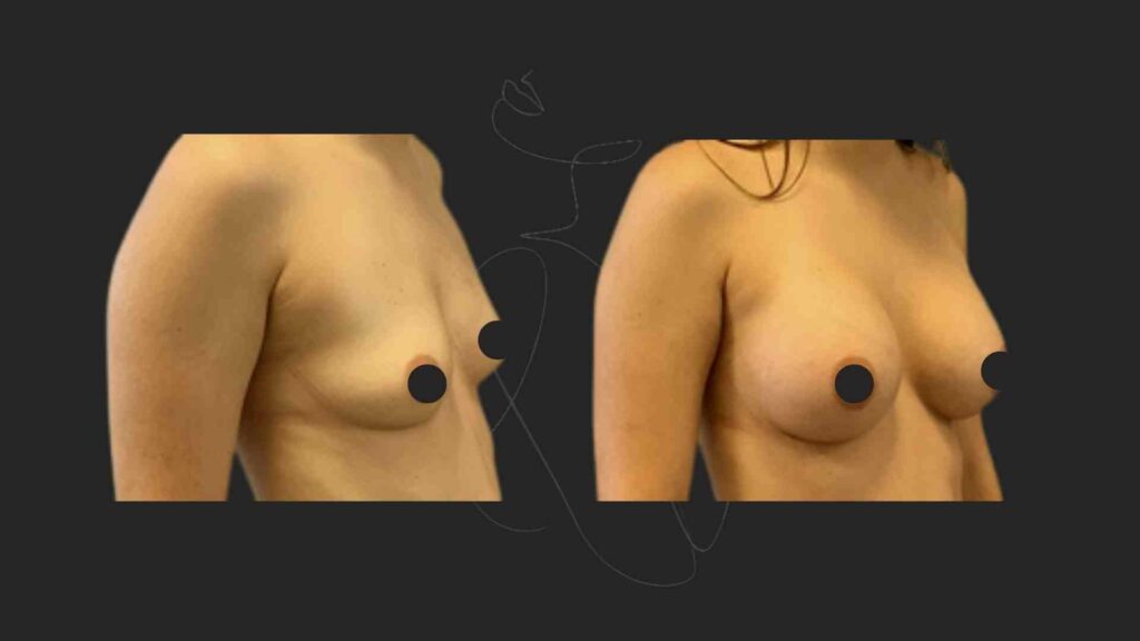 Breast Augmentation NYC