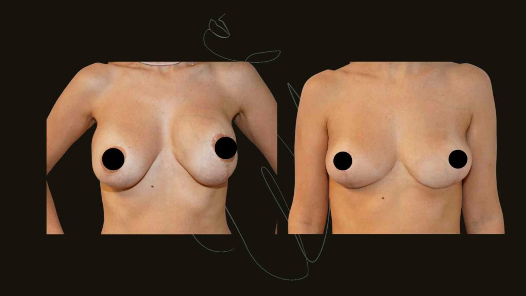 Breast Implant Removal NYC