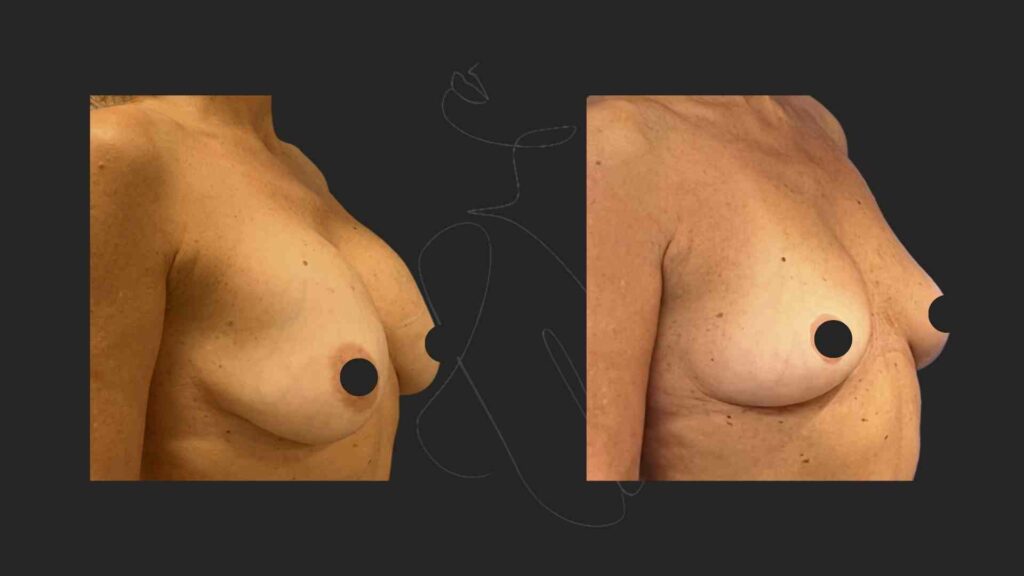 Breast implant Removal NYC