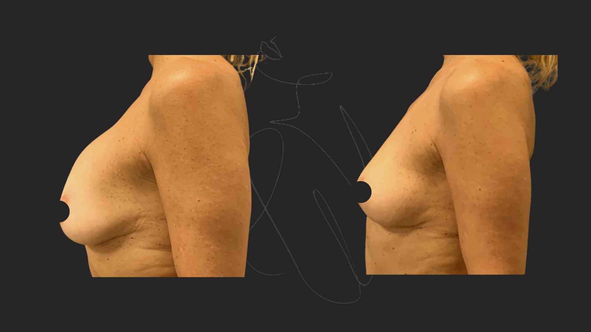 Breast implant Removal NYC