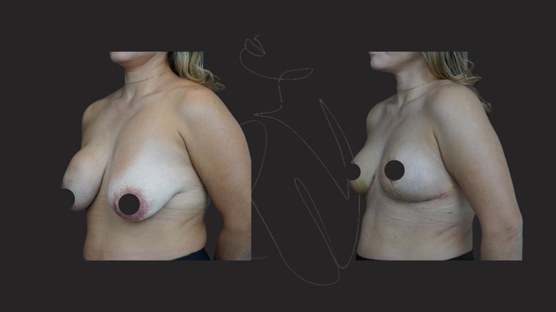 Breast Implant Removal NYC