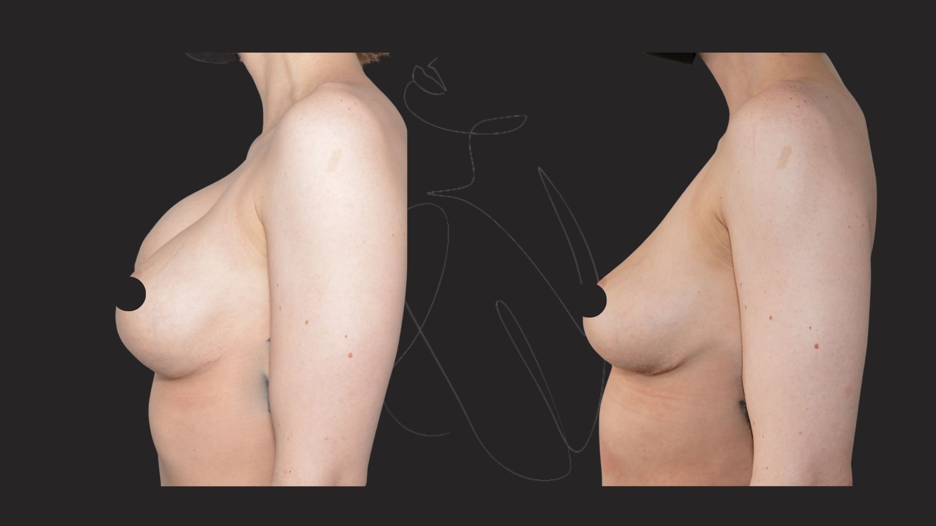 Breast Implant Removal NYC