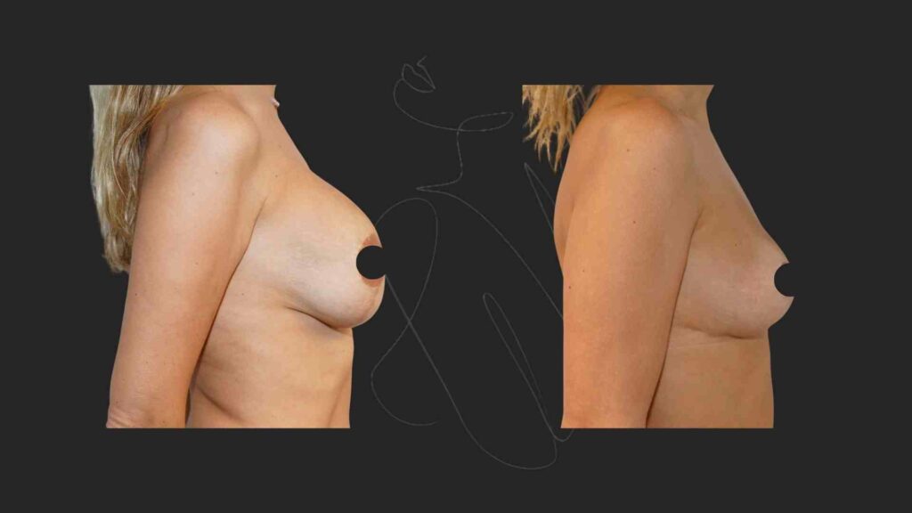 Breast Implant Removal NYC