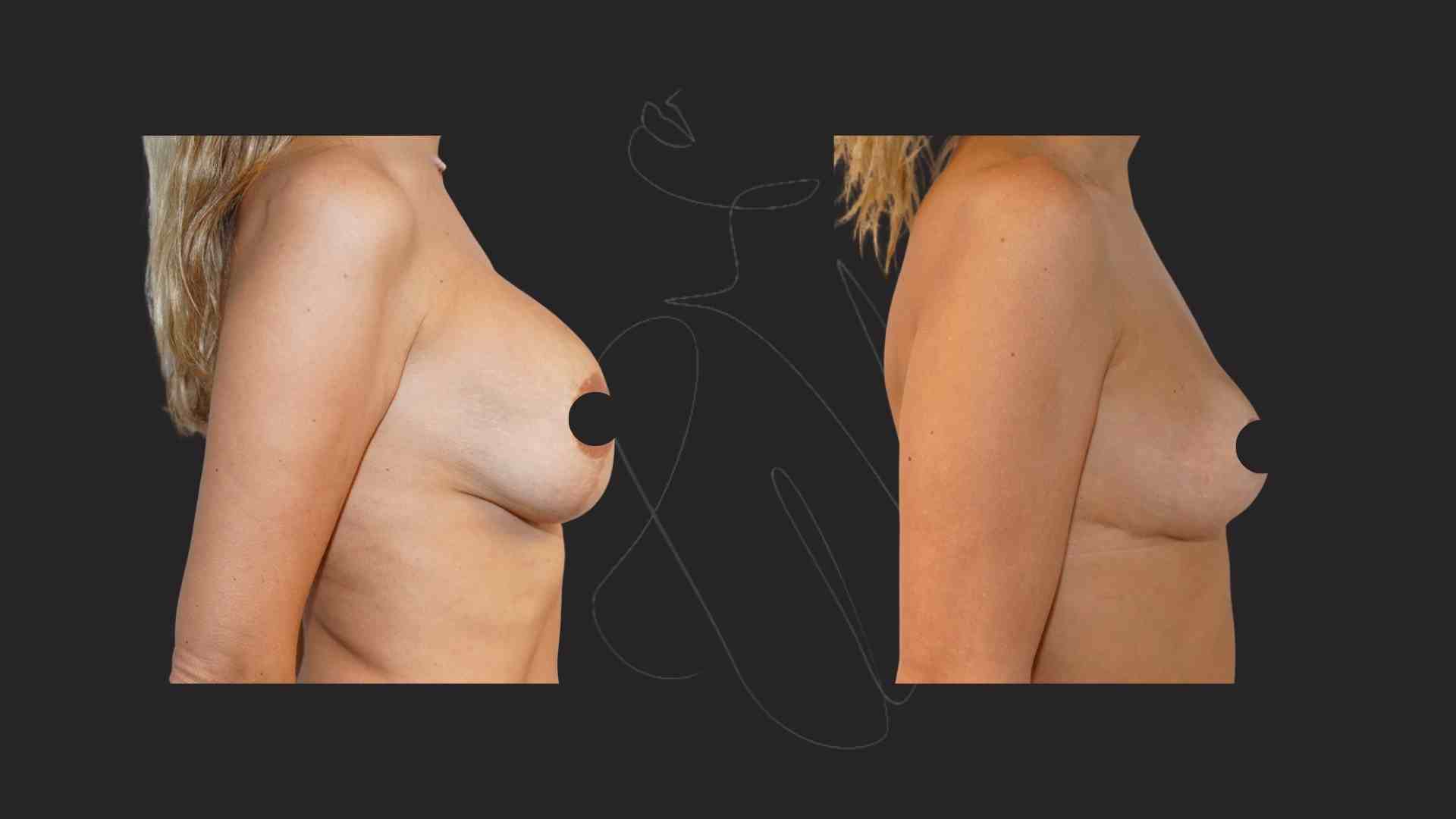 Breast Implant Removal NYC