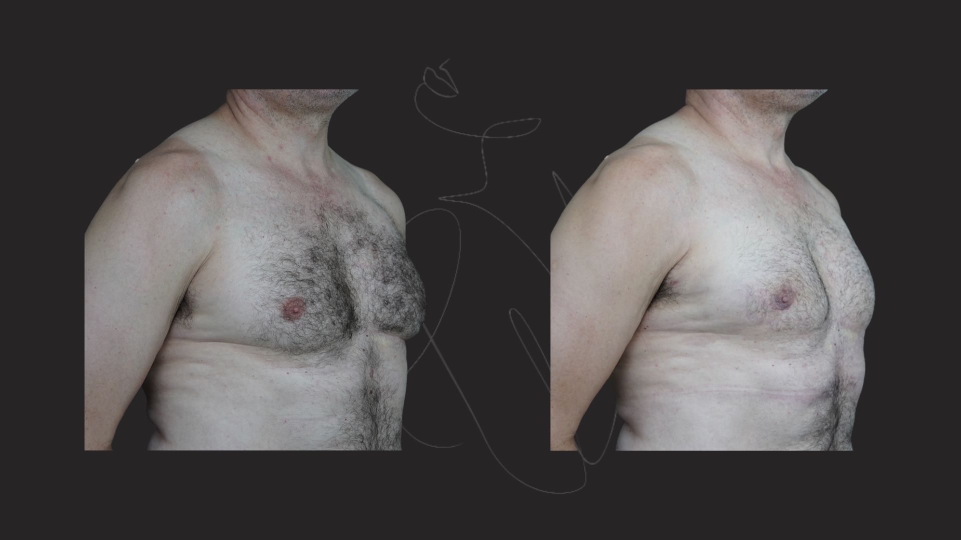Gynecomastia NYC Before After