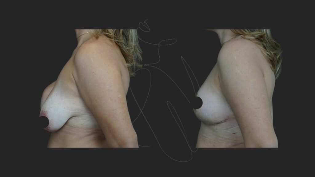 Breast Implant Removal NYC