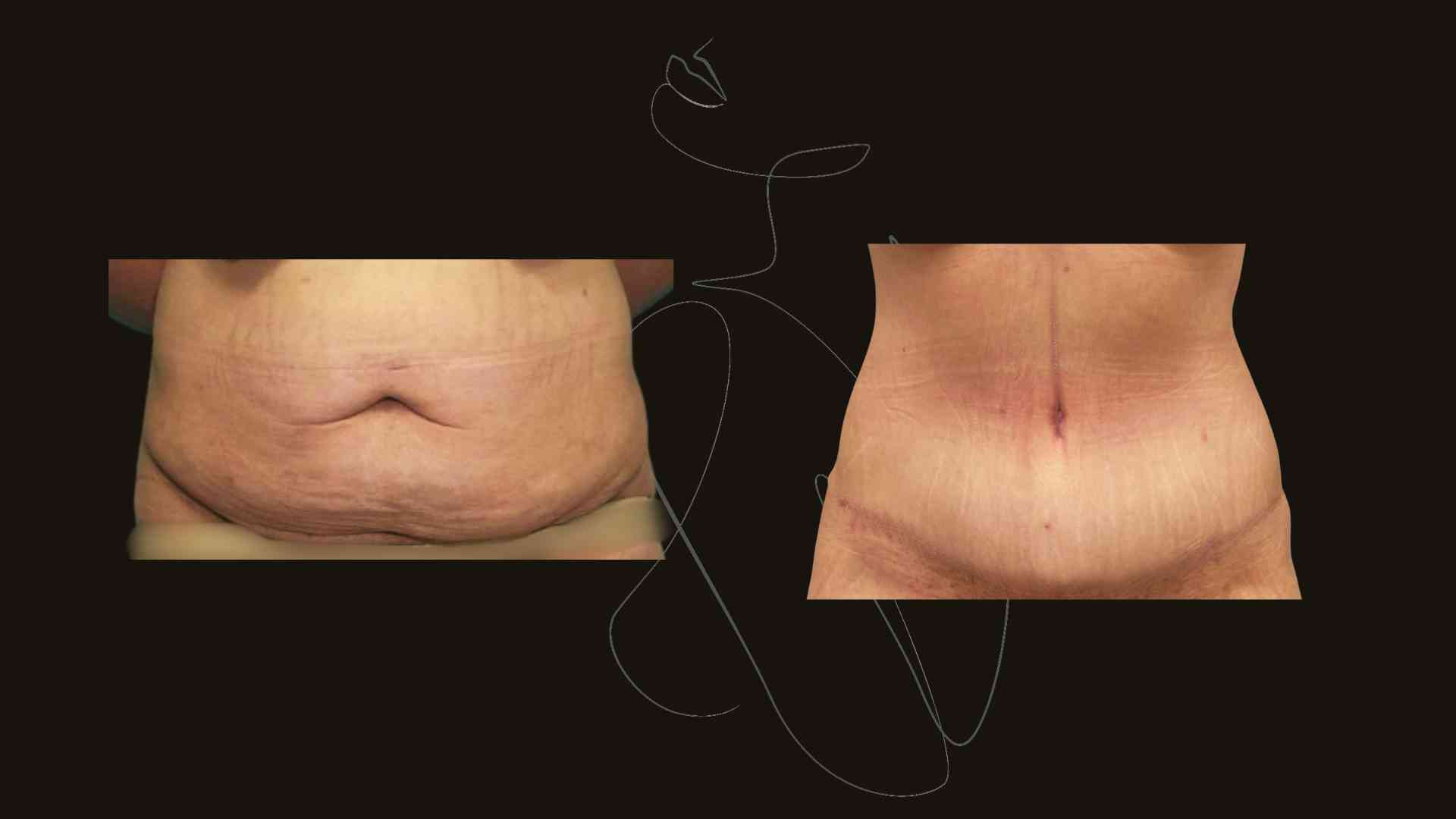 Gallery Tummy Tuck (Abdominoplasty ) NYC