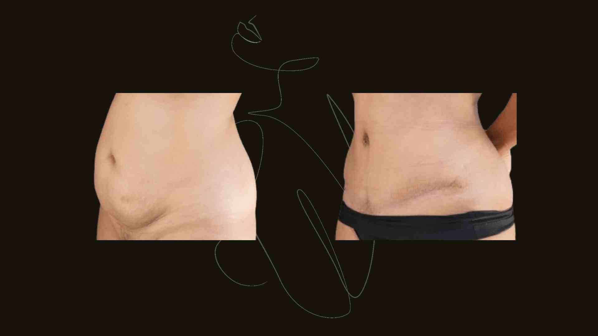 Gallery Tummy Tuck (Abdominoplasty ) NYC