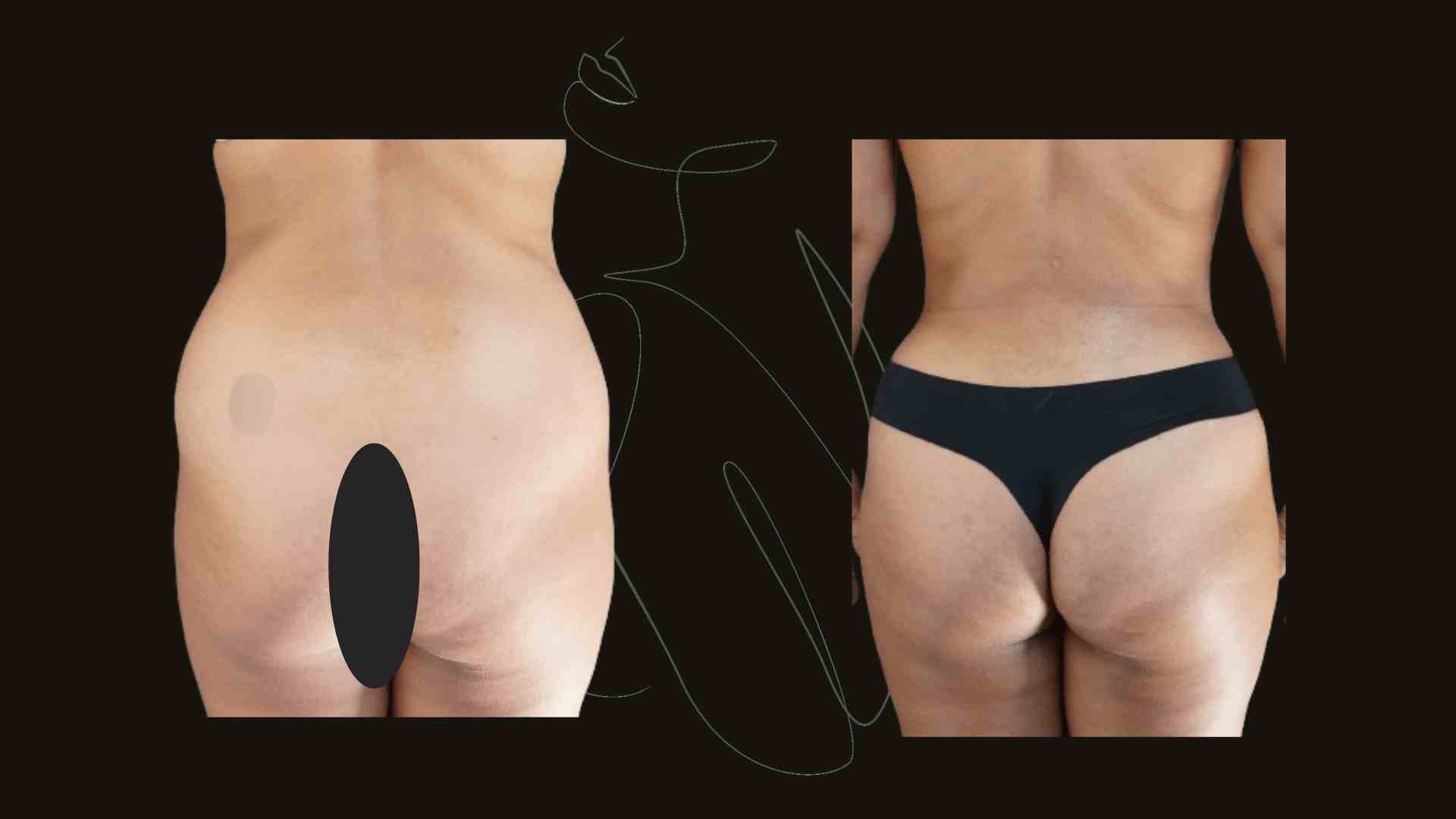 Gallery Tummy Tuck (Abdominoplasty ) NYC