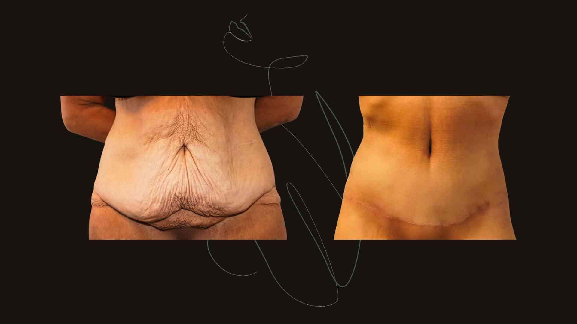 Gallery Tummy Tuck NYC