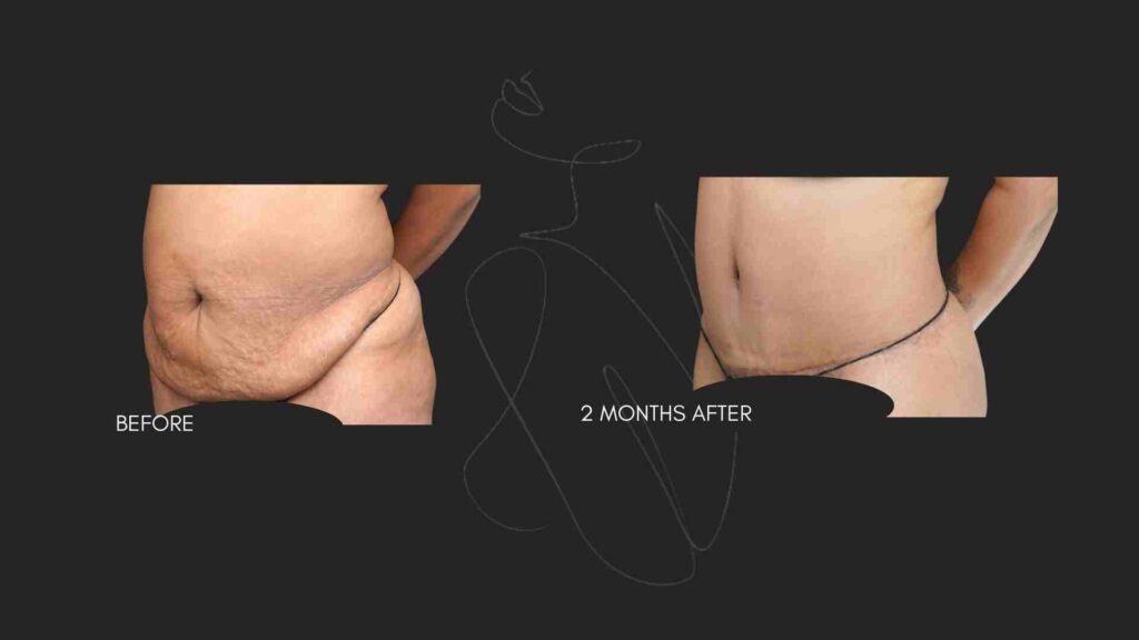 Tummy Tuck (Abdominoplasty ) NYC