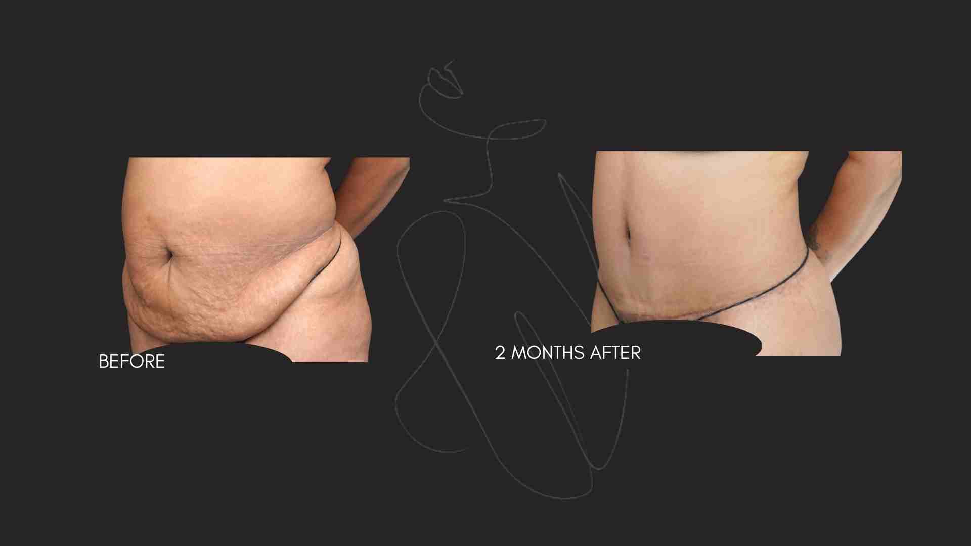 Gallery Tummy Tuck (Abdominoplasty ) NYC