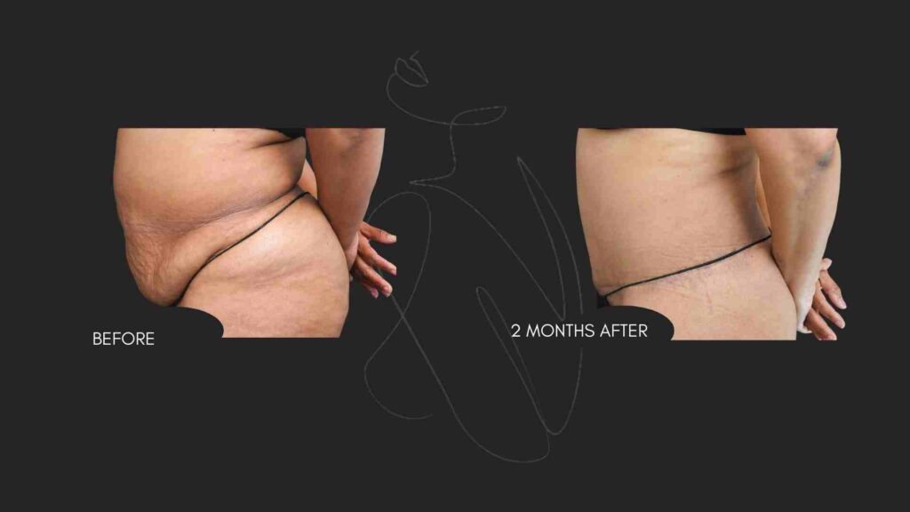Tummy Tuck (Abdominoplasty ) NYC
