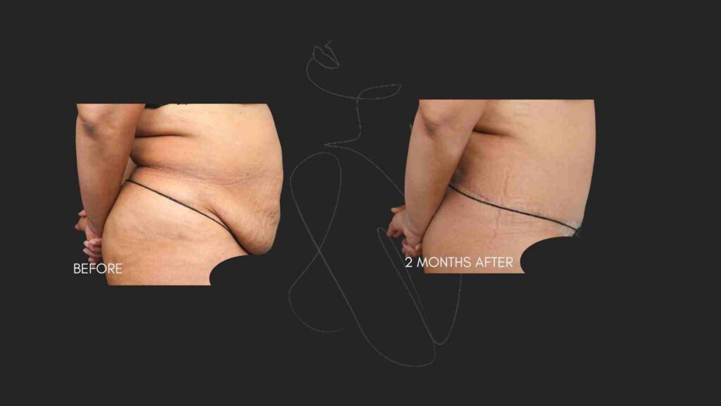 Tummy Tuck (Abdominoplasty) NYC