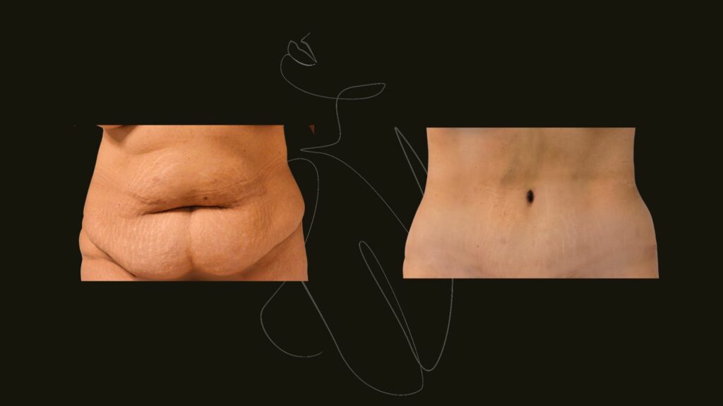 Tummy Tuck NYC