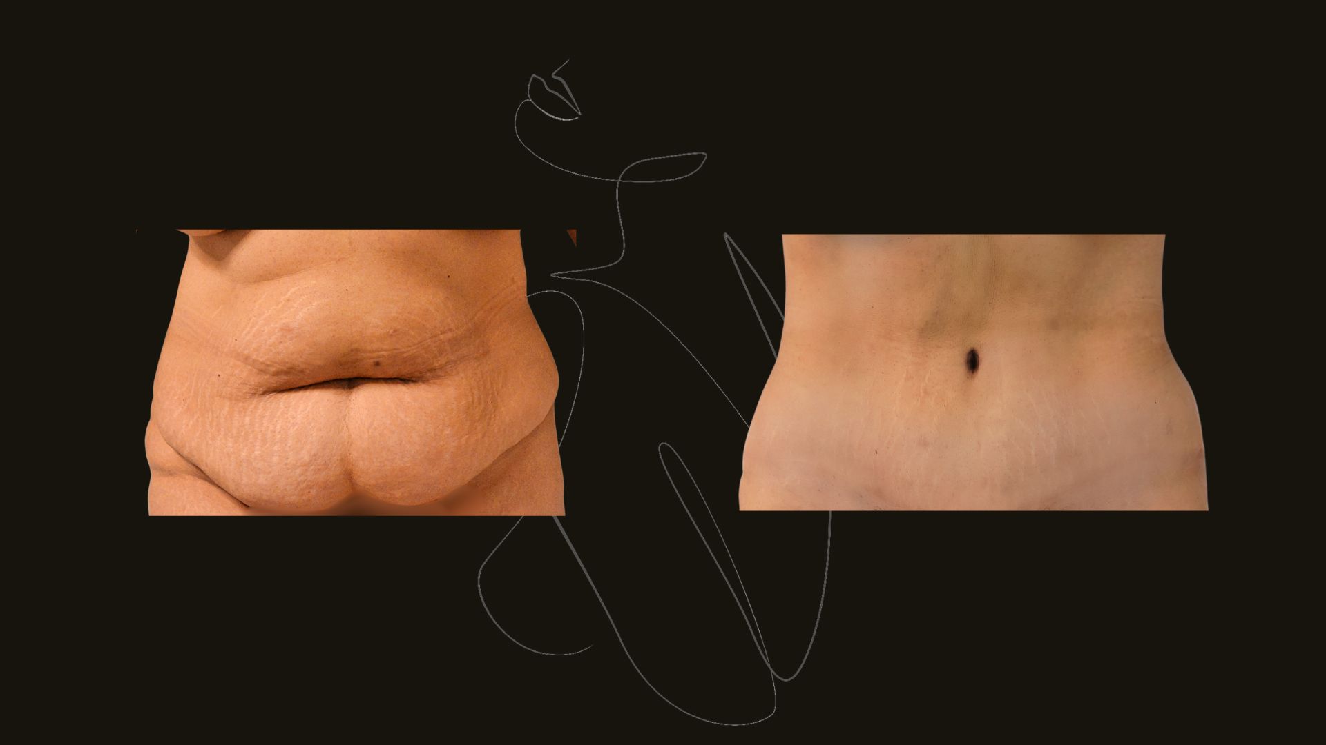 Gallery Tummy Tuck NYC