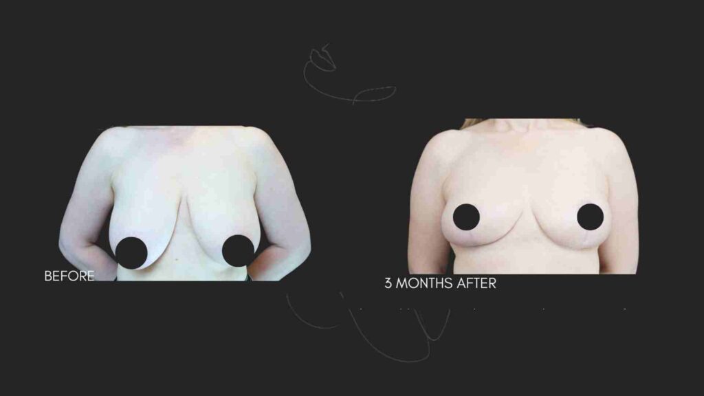 Breast Reduction NYC