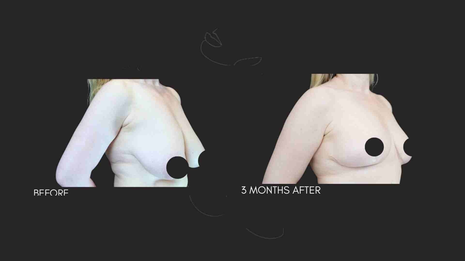 Breast Reduction NYC