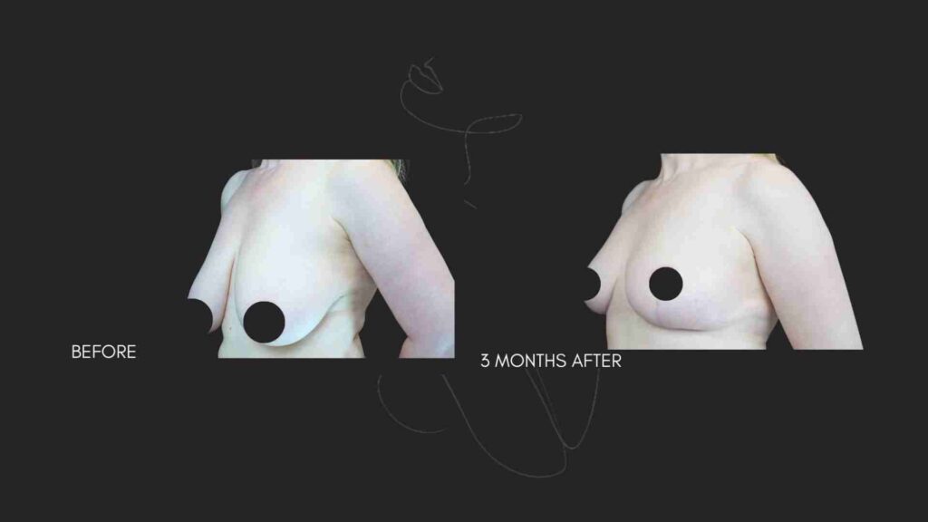 Breast Reduction NYC