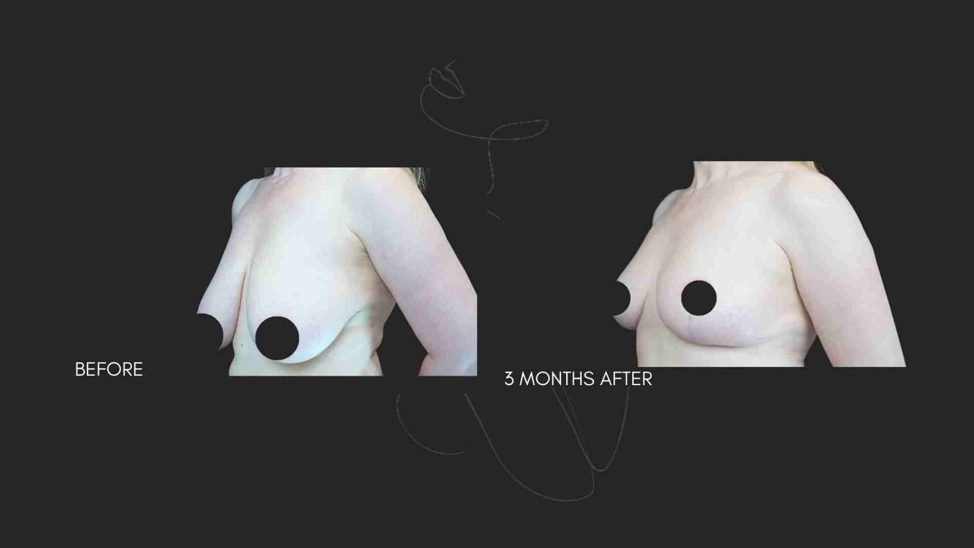 Breast Reduction NYC