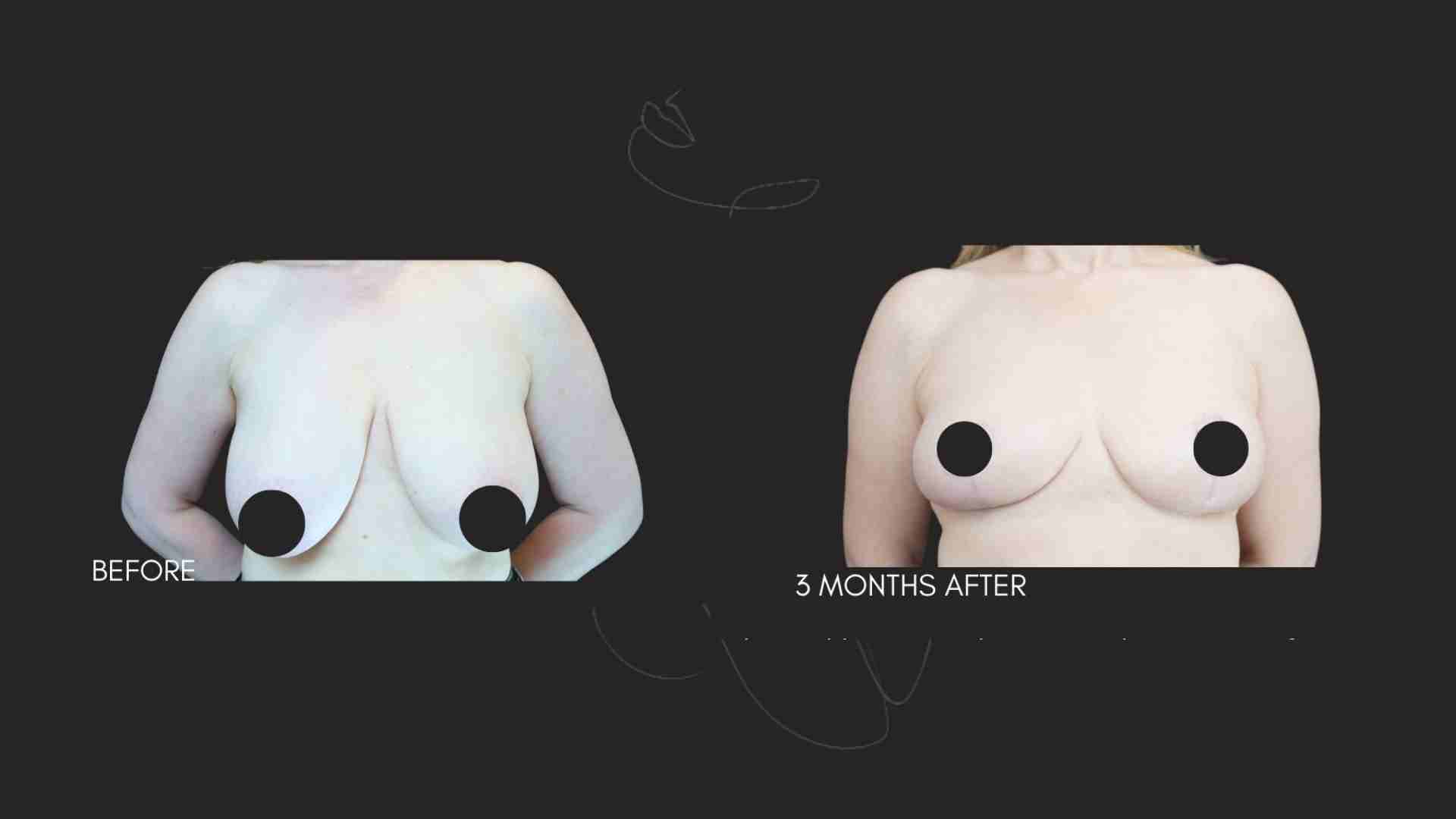Breast Reduction NYC